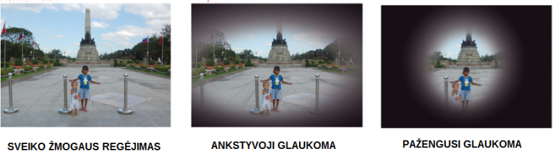 Glaukoma